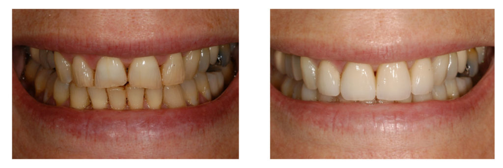 STUDIO INSERRA odontoiatri - Le faccette dentali: un sorriso su misura