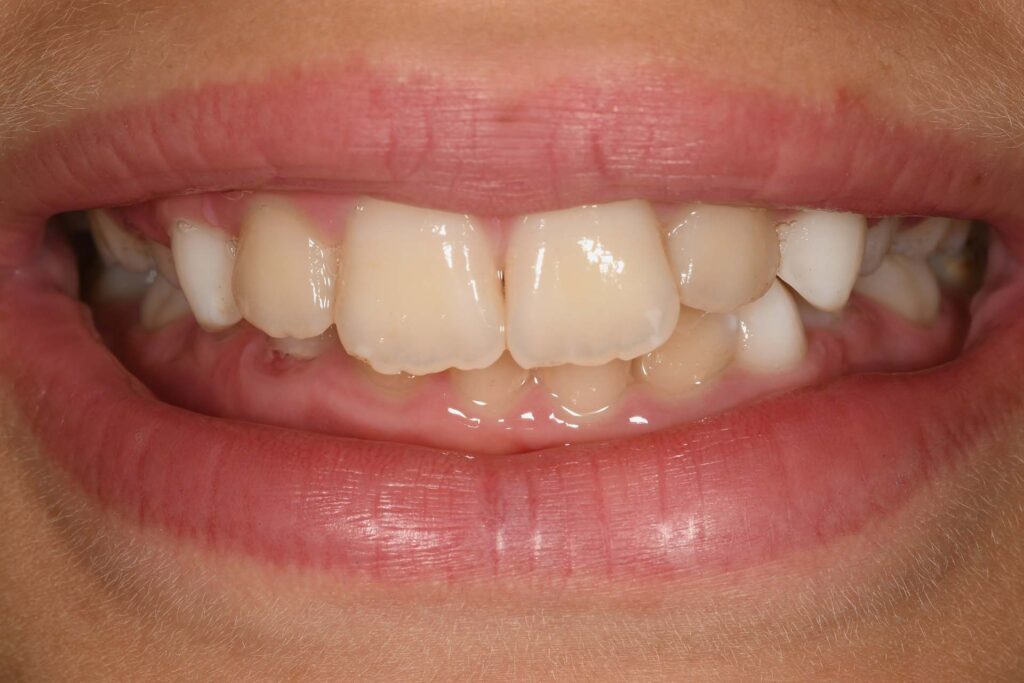 Black stains dopo il trattamento con il programma specifico: sedute di igiene/integratori e dentifrici con lattoferrina
