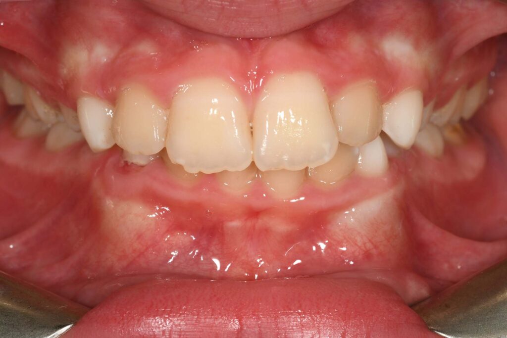 Black stains dopo il trattamento con il programma specifico: sedute di igiene/integratori e dentifrici con lattoferrina